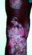 chromoblastomycosis