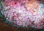 chromoblastomycosis