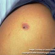 Photo of a mold infection on the skin