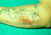 Photo of man with mold growing on his arm