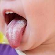 Children can have candida infection in their mouths Little child with candida infection on his tongue