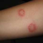 Ringworm on a child’s arm Photo of ringworm on child's arm