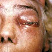 Individual with Mucormycosis of the eye