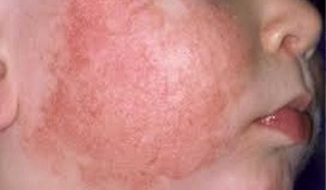 Child with Aspergillosis on his cheek with doctors diagnosis