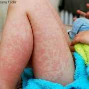 Child with a skin rash from mold on his legs