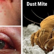 Dust-Mites Collage of dust mite and neck and ear with bites